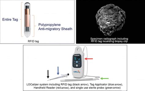 why is there rf tag in breast|rfid for breast cancer.